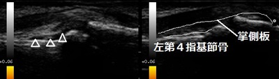 突き指20171020183118_1835340.jpg