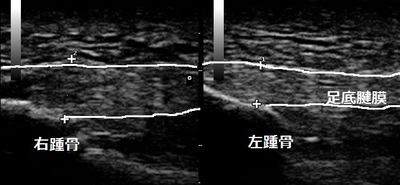 かかとの痛み20171013110452_1115441.jpg