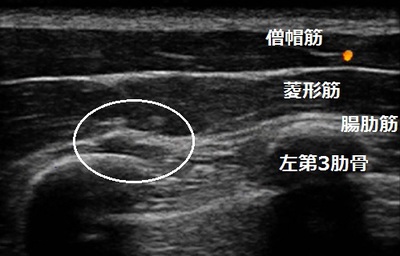 左背部痛　douga ht.jpg