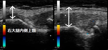 半月大腿靭帯の腫れ20171101161101_1614230.jpg