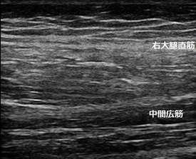 右もも（大腿部）筋周膜損傷20171225155753_1600500.jpg