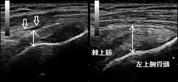 腱板断裂20180105154043_1549230.jpg