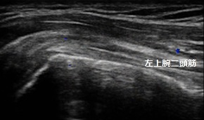 上腕二頭筋長頭腱炎　douga tk1.jpg