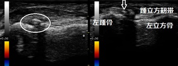 踵骨前縁裂離骨損傷　20180131173450_1745180.jpg