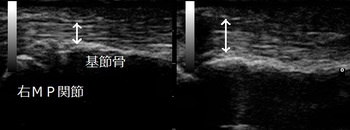 ばね指　腱鞘炎20180210110620_1111120.jpg