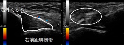 足首捻挫　前距腓靭帯損傷20180503003028_0032440.jpg