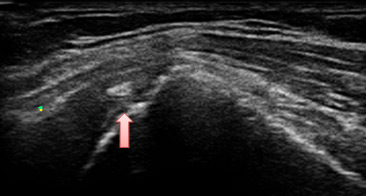 左肩、棘上筋のエコー画像