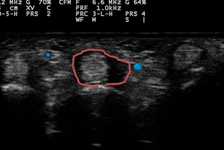 左中指屈筋腱の腱鞘炎エコー画像
