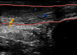 左アキレス腱炎のエコー画像