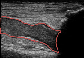 左膝上部の血腫エコー長軸画像